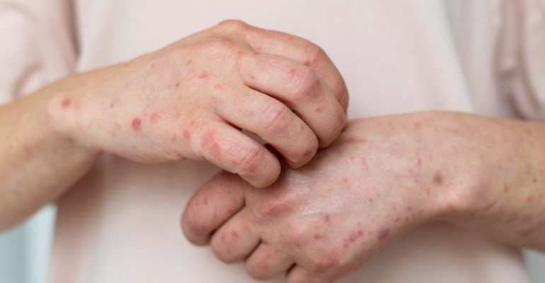 Kenali gejala campak